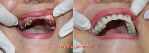 cấy ghép implant nguyên hàm răng trên