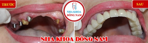 Trồng răng Implant và Phục hình răng sứ hàm trên