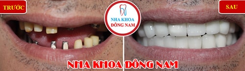 Cấy ghép Implant phục hình 2 hàm sứ