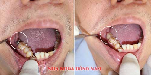 cấy ghép implant răng nhai cối lớn