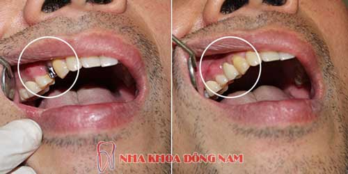 cấy ghép răng implant hàm trên