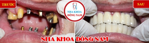 Cấy ghép Implant phục hình 2 hàm sứ