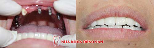 cấy ghép răng 9 trụ implant hàm trên
