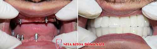 cấy ghép răng Implant 2 hàm - 15062016