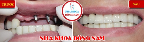 Cắm ghép răng implant và phục hình răng sứ cho trường hợp mất răng hàm trên