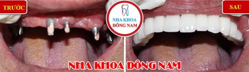Cấy ghép implant toàn hàm trên