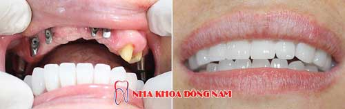 cấy ghép răng implant nguyên hàm trên -27062016