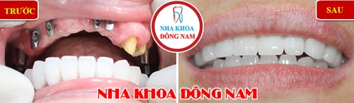 Cắm ghép Implant và Phục hình răng sứ hàm trên