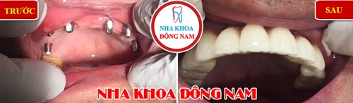 Cấy ghép Implant toàn hàm trên