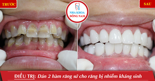Dán 2 hàm răng sứ cho răng bị nhiễm kháng sinh