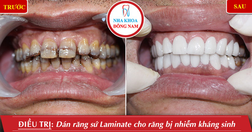 Dán 2 hàm răng sứ cho răng nhiễm kháng sinh