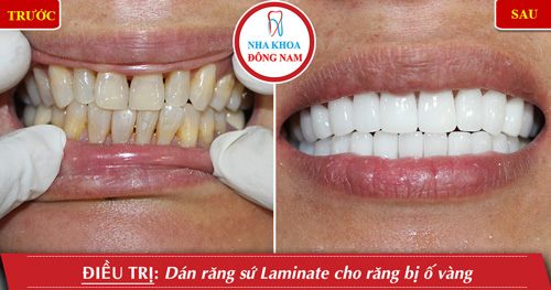 Dán 2 hàm răng sứ cho răng bị ố vàng
