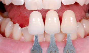 giải pháp bọc răng sứ