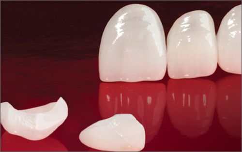 mặt dán sứ laminate