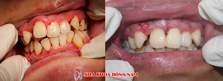 phẫu thuật chỉnh hình răng bị chìa