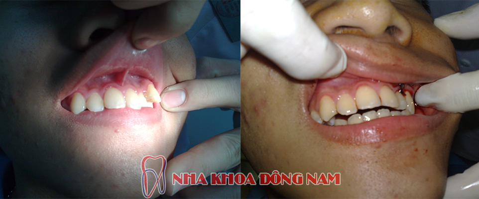 phẫu thuật chỉnh hình răng bị lệch