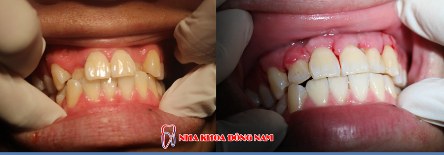 phẫu thuật chình hình răng không đều