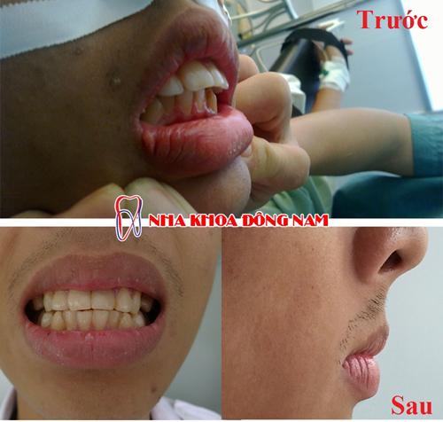 phẫu thuật hàm hô