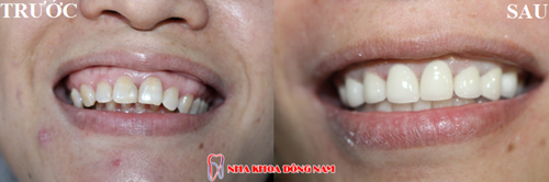 phẫu thuật cười hở lợi