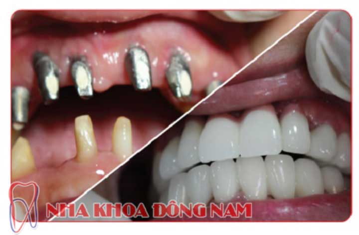 quy trình cấy ghép implant 5
