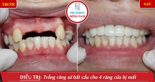 trồng răng sứ bắt cầu 4 răng cửa bị mất