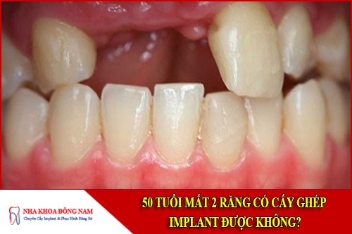 50 tuổi bị mất 2 răng có cấy ghép implant được không