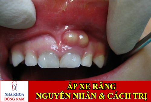 nguyên nhân và cách điều trị áp xe răng
