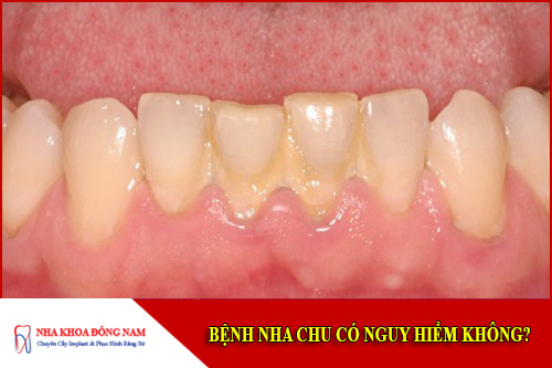 bệnh nha chu có nguy hiểm không