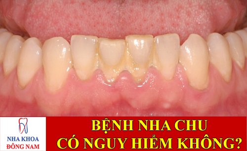 bệnh nha chu có nguy hiểm không -4
