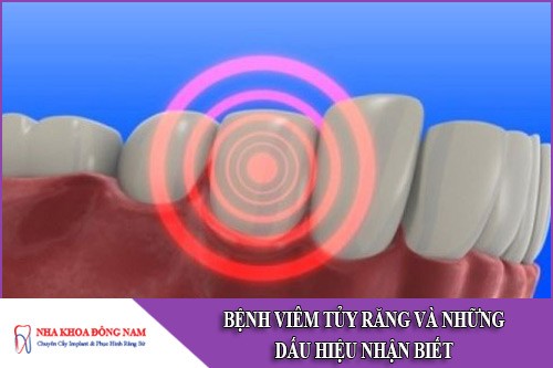 bệnh viêm tủy răng và những dấu hiệu nhận biết