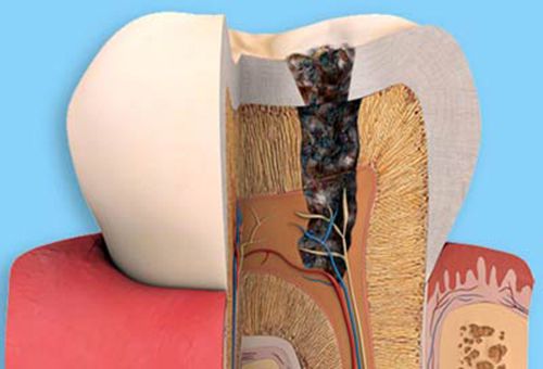 bọc răng sứ có cần lấy tủy không
