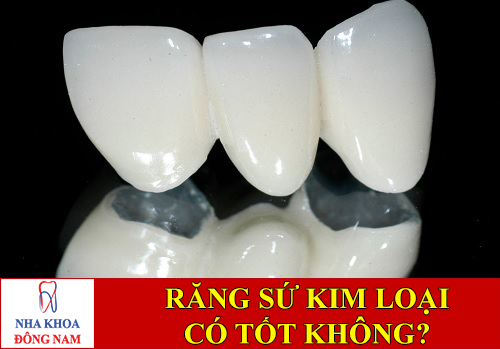 bọc răng sứ kim loại có tốt không -1