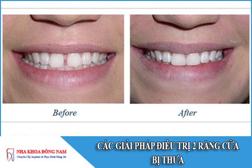 các giải pháp điều trị 2 răng cửa bị thưa