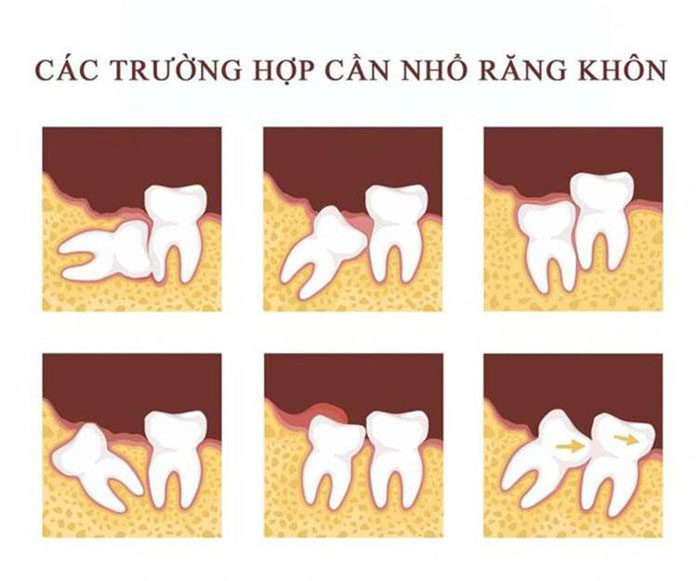 Các trường hợp nên nhổ răng khôn