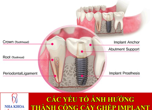 các yếu tố ảnh hưởng sự thành công cấy ghép implant -1