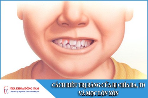 cách điều trị răng cửa bị chìa ra, to và mọc lộn xộn