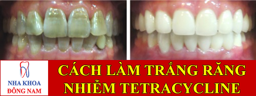 cách làm trắng răng nhiễm tetracycline -1