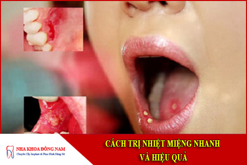 Cách trị nhiệt miệng nhanh và hiệu quả