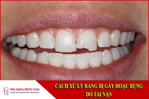 cách xử lý răng bị gãy hoặc rụng do tai nạn