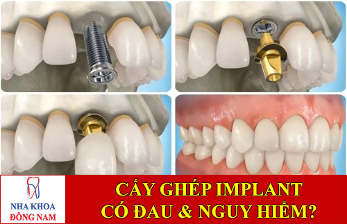 cấy ghép implant có đau không?