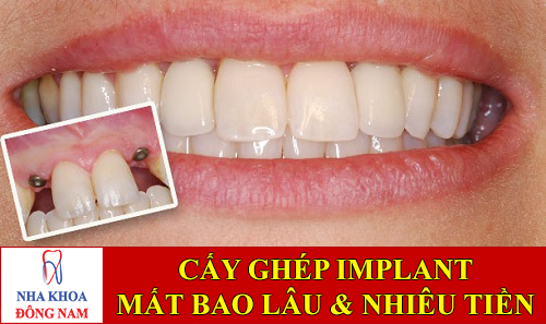 cấy ghép implant mất thời gian bao lâu -1