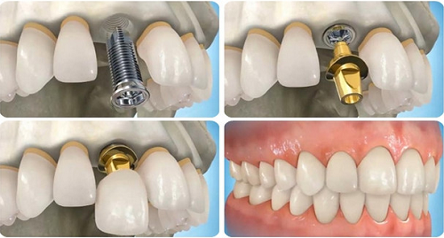cấy ghép răng implant là gì