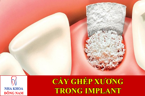 cấy ghép xương trong implant