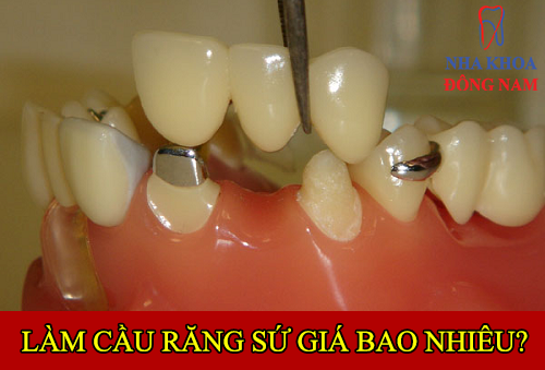 chi phí làm cầu răng sứ