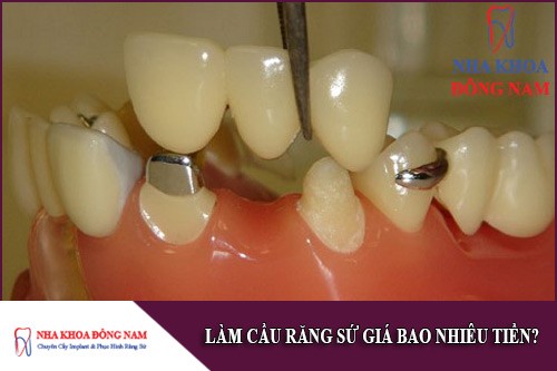 chi phí làm cầu răng sứ giá bao nhiêu tiền