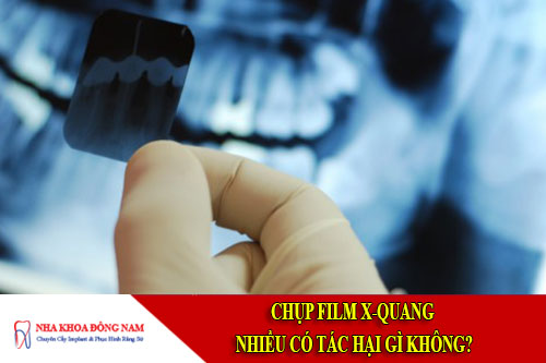 chụp film x quang có tác hại gì không
