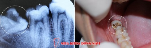 chụp film x quang nhiều có tác hại gì không