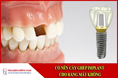 Có nên cấy ghép implant cho răng bị mất không