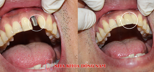 có nên cấy ghép implant không