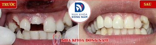 khi nào mới nên đi trám răng 3